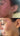 nodular acne, facial scars, acne before and afters, ice pick scars, pimple scars, facials for acne near me, acne extraction, benzoyl peroxide before and after