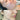 nodular acne, facial scars, acne before and afters, ice pick scars, pimple scars, facials for acne near me, acne extraction, benzoyl peroxide before and after