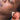 nodular acne, facial scars, acne before and afters, ice pick scars, pimple scars, facials for acne near me, acne extraction, benzoyl peroxide before and after