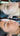 nodular acne, facial scars, acne before and afters, ice pick scars, pimple scars, facials for acne near me, acne extraction, benzoyl peroxide before and after