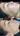 nodular acne, facial scars, acne before and afters, ice pick scars, pimple scars, facials for acne near me, acne extraction, benzoyl peroxide before and after