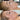 nodular acne, facial scars, acne before and afters, ice pick scars, pimple scars, facials for acne near me, acne extraction, benzoyl peroxide before and after