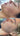 nodular acne, facial scars, acne before and afters, ice pick scars, pimple scars, facials for acne near me, acne extraction, benzoyl peroxide before and after