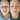 nodular acne, facial scars, acne before and afters, ice pick scars, pimple scars, facials for acne near me, acne extraction, benzoyl peroxide before and after