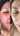 nodular acne, facial scars, acne before and afters, ice pick scars, pimple scars, facials for acne near me, acne extraction, benzoyl peroxide before and after