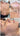 nodular acne, facial scars, acne before and afters, ice pick scars, pimple scars, facials for acne near me, acne extraction, benzoyl peroxide before and after