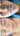 nodular acne, facial scars, acne before and afters, ice pick scars, pimple scars, facials for acne near me, acne extraction, benzoyl peroxide before and after