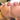 nodular acne, facial scars, acne before and afters, ice pick scars, pimple scars, facials for acne near me, acne extraction, benzoyl peroxide before and after