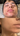 nodular acne, facial scars, acne before and afters, ice pick scars, pimple scars, facials for acne near me, acne extraction, benzoyl peroxide before and after